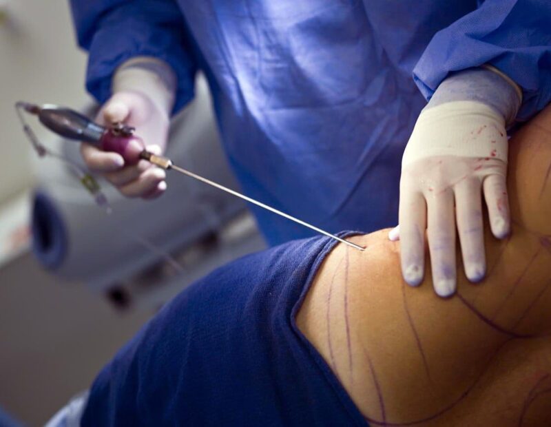 Liposuction Secondary Effects